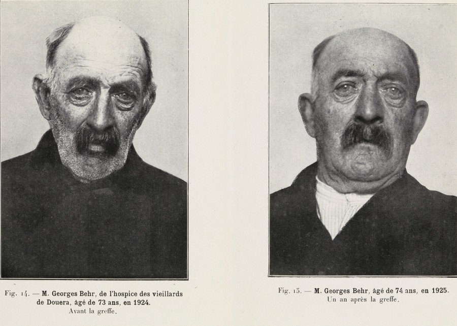 Người đàn ông 74 tuổi, trước và sau một năm ghép tinh hoàn khỉ.