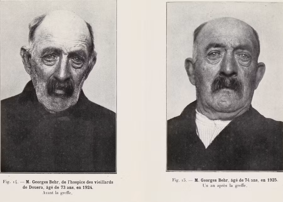 Người đàn ông 74 tuổi, trước và sau một năm ghép tinh hoàn khỉ.