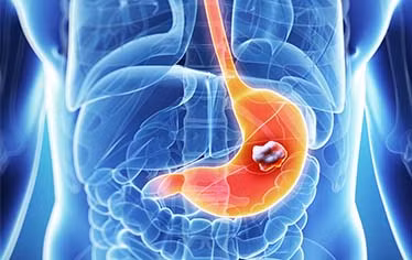 Mắc bệnh ung thư dạ dày vì những món ăn quen thuộc ảnh 3