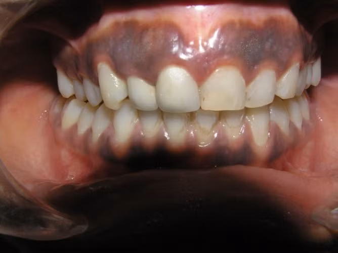 Đường viền Burton quanh chân răng của bệnh nhân nhiễm độc chì. Ảnh minh họa.