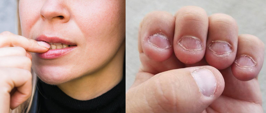 Đối với một số người, cắn móng tay có thể là dấu hiệu của một vấn đề tâm lý. Ảnh: Bệnh viện da liễu Trung ương. Đối với một số người, cắn móng tay có thể là dấu hiệu của một vấn đề tâm lý. Ảnh: Bệnh viện da liễu Trung ương.
