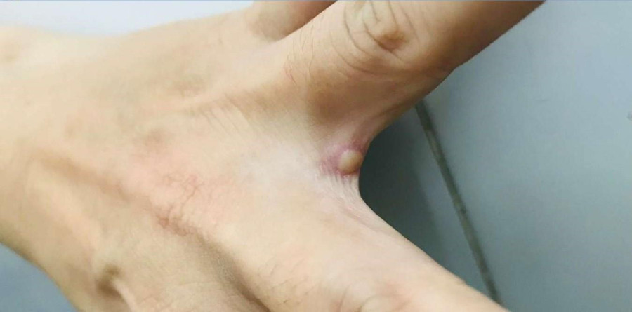 Bóng nước điển hình rải rác các vị trí khác nhau trên cơ thể người bệnh đậu mùa khỉ. Ảnh: BV. Bóng nước điển hình rải rác các vị trí khác nhau trên cơ thể người bệnh đậu mùa khỉ. Ảnh: BV.