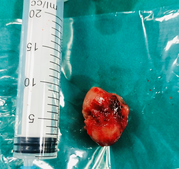 Hình ảnh khối u sau khi được phẫu thuật. Ảnh: BV. Hình ảnh khối u sau khi được phẫu thuật. Ảnh: BV.