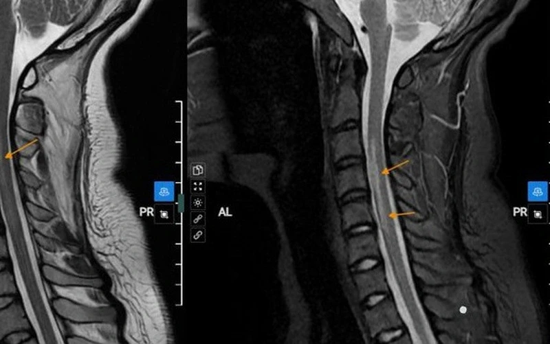 Bệnh nhân tổn thương tăng tín hiệu trong tủy cổ đoạn ngang mức đốt sống C3-C6. Ảnh: BVCC. 