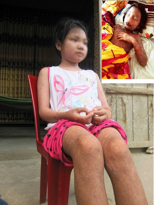 Sự thật về bé gái bị bỏng rộp toàn thân, suýt chết vì uống nước ngọt - Ảnh 1 Sự thật về bé gái bị bỏng rộp toàn thân, suýt chết vì uống nước ngọt - Ảnh 1