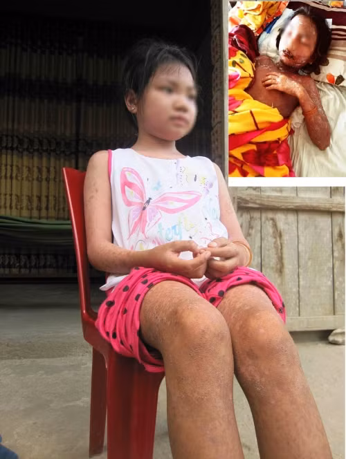 Sự thật về bé gái bị bỏng rộp toàn thân, suýt chết vì uống nước ngọt - Ảnh 1 Sự thật về bé gái bị bỏng rộp toàn thân, suýt chết vì uống nước ngọt - Ảnh 1