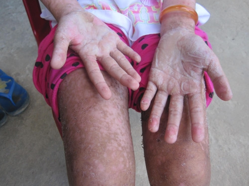 Sự thật về bé gái bị bỏng rộp toàn thân, suýt chết vì uống nước ngọt - Ảnh 2 Sự thật về bé gái bị bỏng rộp toàn thân, suýt chết vì uống nước ngọt - Ảnh 2