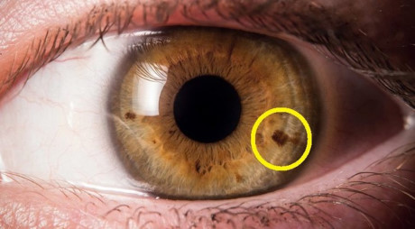 Xuất hiện đốm nhỏ trong tròng mắt báo hiệu điều gì? - Ảnh 1 Xuat hien dom nho trong trong mat bao hieu dieu gi? - Anh 1