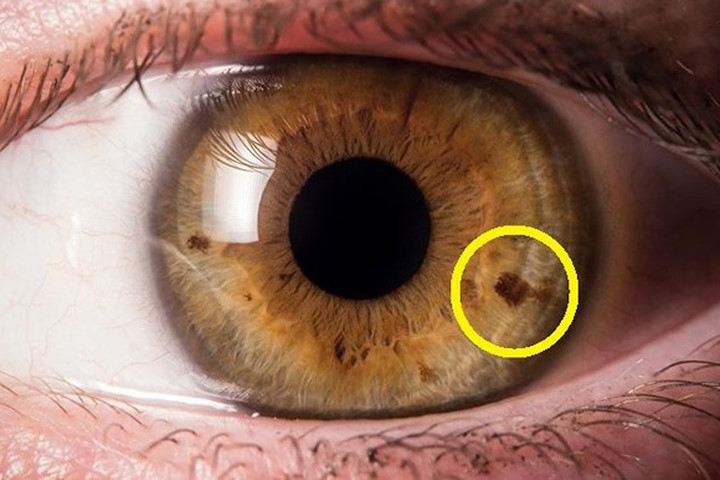 Xuất hiện đốm nhỏ trong tròng mắt báo hiệu điều gì?