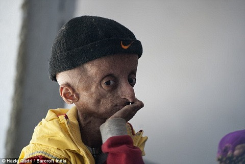 Tốc độ lão hóa cơ thể của Nahil nhanh hơn gấp 8 lần bình thường