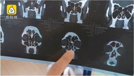 Anh Zhang thường xuyên khó thở. Anh Zhang thường xuyên khó thở.