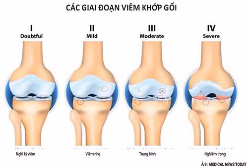 Viêm khớp gối, triệu chứng và trị liệu