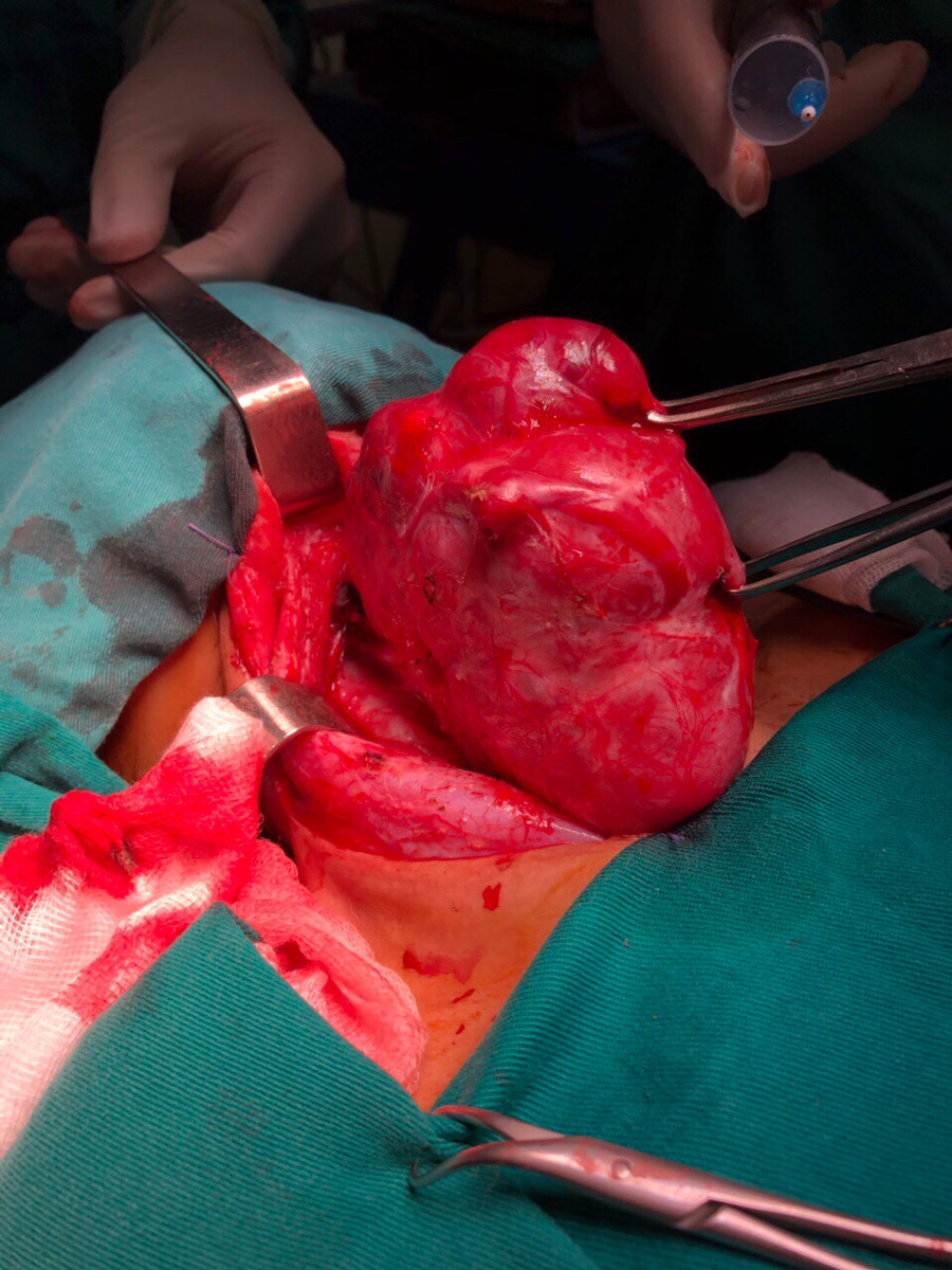 Khối u tuyến giáp có kích thước lớn