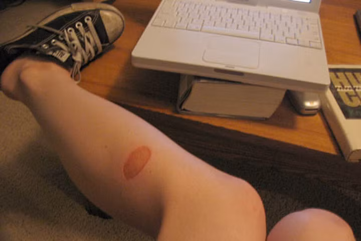 Bí quyết chữa bỏng bô xe máy không để lại sẹo