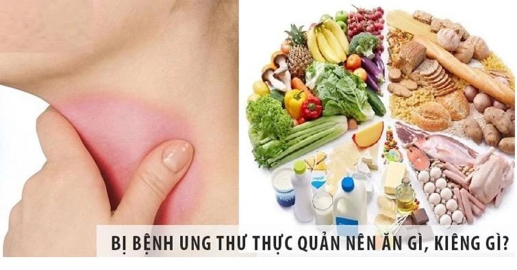 Ung thư thực quản đứng thứ 5 trong số các loại ung thư thường gặp.