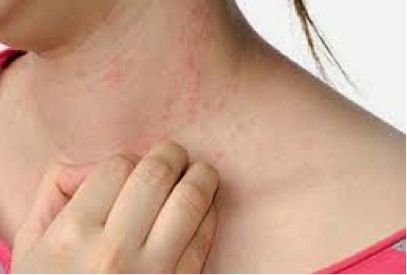 bệnh nhân bị mề đay