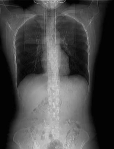 Người phụ nữ lên cơn ho vì thức ăn cay làm gãy 4 chiếc xương sườn. Ảnh: SCMP. Người phụ nữ lên cơn ho vì thức ăn cay làm gãy 4 chiếc xương sườn. Ảnh: SCMP.