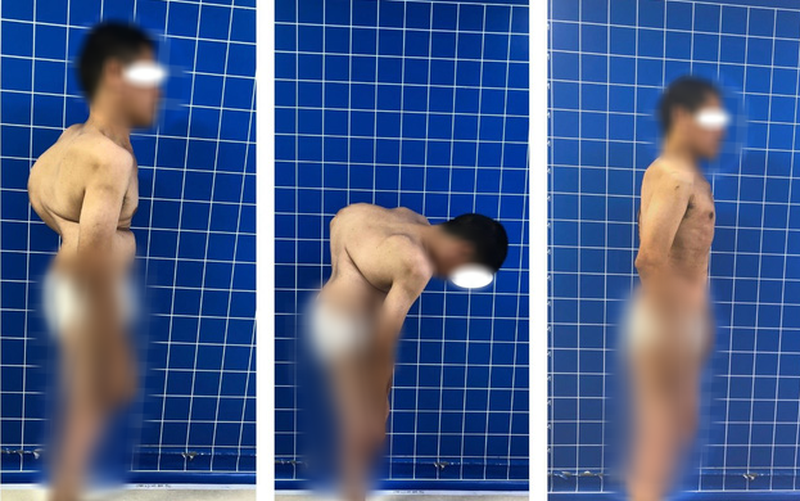 Bệnh nhân bị cong vẹo cột sống nặng. Ảnh: BV. Bệnh nhân bị cong vẹo cột sống nặng. Ảnh: BV.