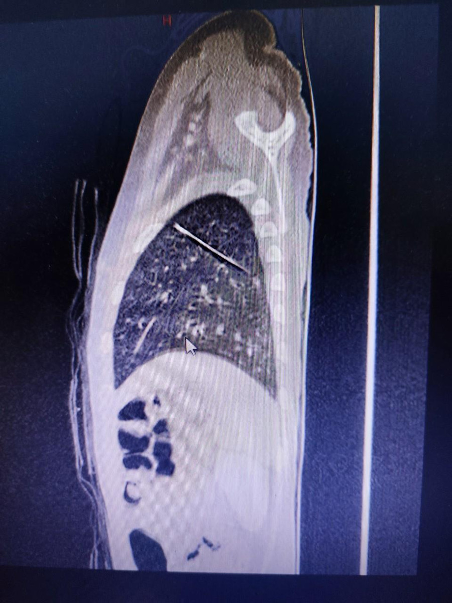 Ảnh chụp cho thấy rõ vị trí chiếc kim may áo quần trong phổi của bé. Ảnh: BV. Ảnh chụp cho thấy rõ vị trí chiếc kim may áo quần trong phổi của bé. Ảnh: BV.