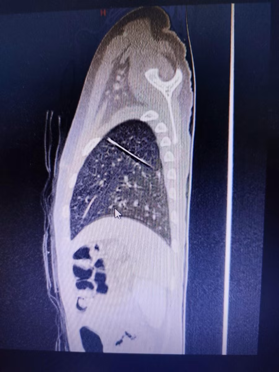 Ảnh chụp cho thấy rõ vị trí chiếc kim may áo quần trong phổi của bé. Ảnh: BV.