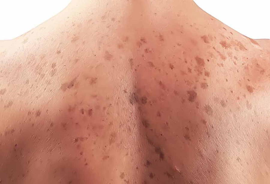 70% bệnh xuất hiện trên các nốt ruồi bẩm sinh thường gặp ở các vùng da bị tỳ đè, cọ sát. Ảnh minh họa. 70% bệnh xuất hiện trên các nốt ruồi bẩm sinh thường gặp ở các vùng da bị tỳ đè, cọ sát. Ảnh minh họa.