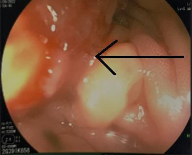 Hình ảnh nội soi đại tràng có khối sùi loét chiếm gần hết chu vi lòng ruột. Ảnh: BV. Hình ảnh nội soi đại tràng có khối sùi loét chiếm gần hết chu vi lòng ruột. Ảnh: BV.