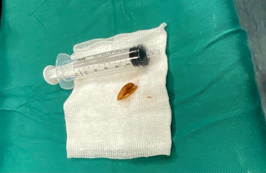 Vỏ hạt hướng dương trong khí quản - nguyên nhân chính dẫn tới tình trạng viêm phổi của trẻ. Ảnh: BVCC.