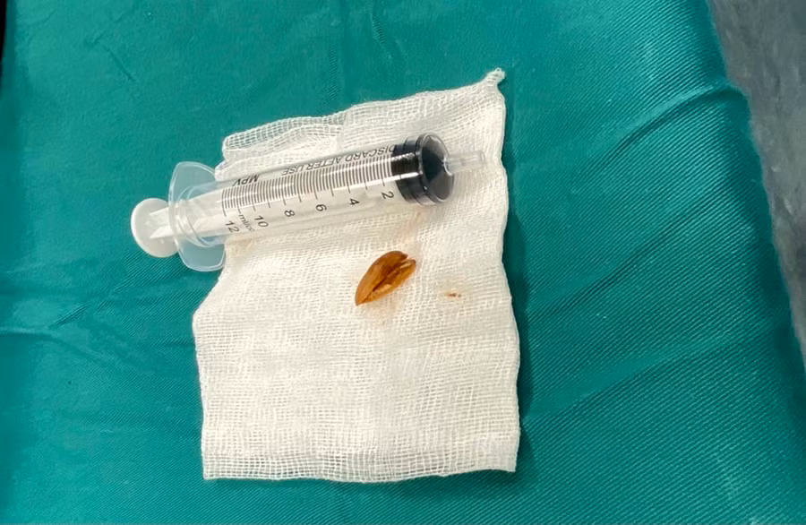 Vỏ hạt hướng dương trong khí quản - nguyên nhân chính dẫn tới tình trạng viêm phổi của trẻ. Ảnh: BVCC.