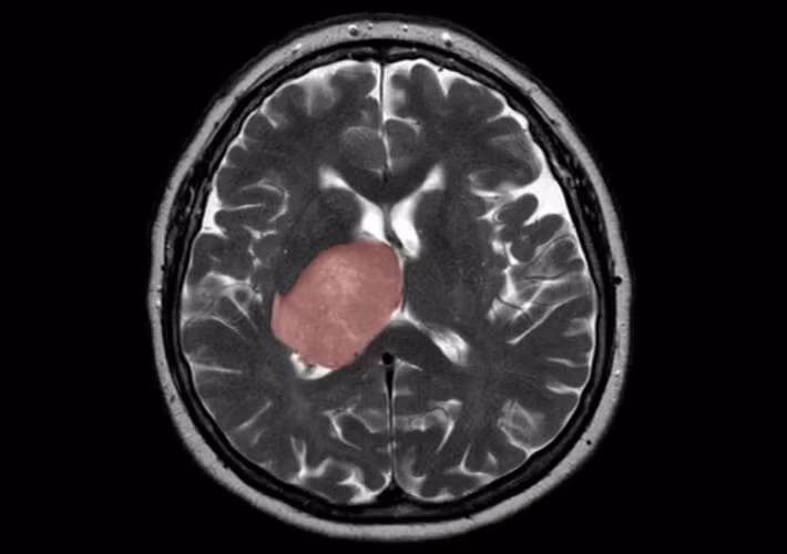 Khối u nguyên bào thần kinh đệm trong não.