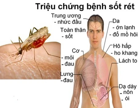 Triệu chứng bệnh sốt rét. Ảnh: SKĐS.