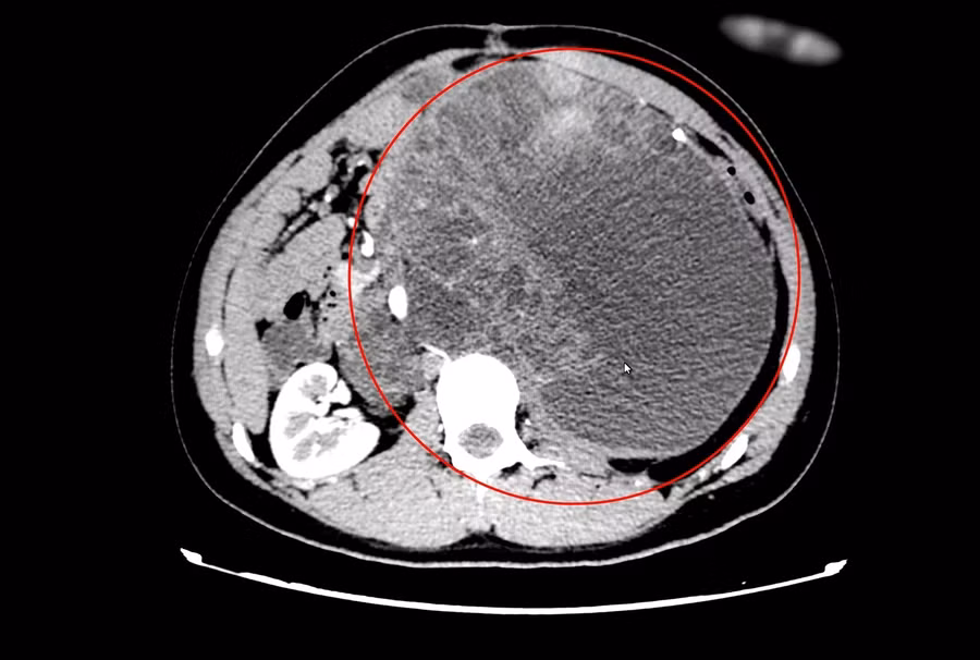 Hình ảnh chụp cắt lớp khối u choán gần hết ổ bụng bệnh nhân.