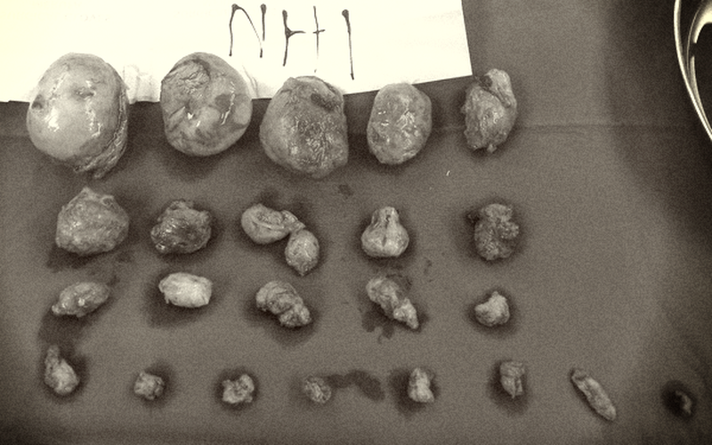 Các khối u xơ được bóc tách cho sản phụ. Ảnh: BV. Các khối u xơ được bóc tách cho sản phụ. Ảnh: BV.