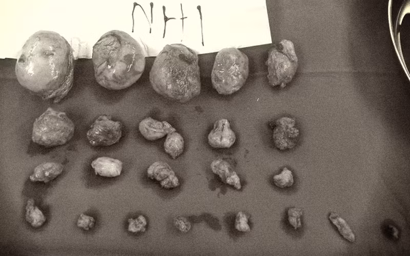 Các khối u xơ được bóc tách cho sản phụ. Ảnh: BV.