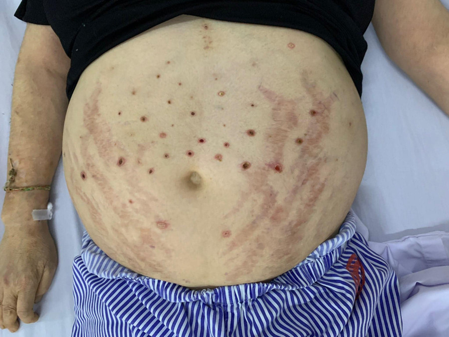 Bệnh nhân bị nhiễm trùng da, với nhiều vết mưng mủ vùng bụng và hai chân do ong châm. (Ảnh: BVCC)