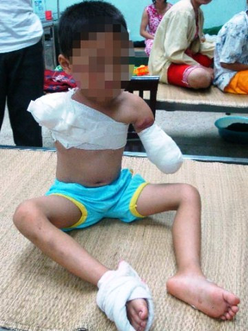 Cháu Q. bị gấu cắn lìa cả hai cánh tay vào năm 2013 (Ảnh: Nhp.org.vn)
