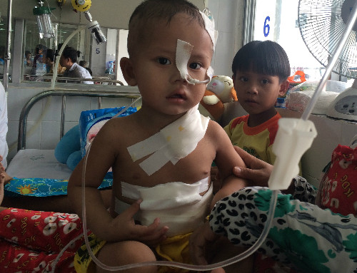 Bệnh nhi uống nhầm axit sau ca phẫu thuật cắt 25 cm ruột già đưa ra làm ống tiêu hóa tại BV Nhi đồng 1 (TP HCM). Ảnh: Lê Phương.