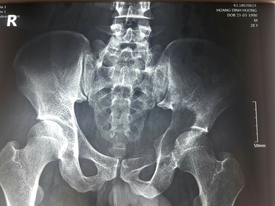 Phim chụp sau phẫu thuật