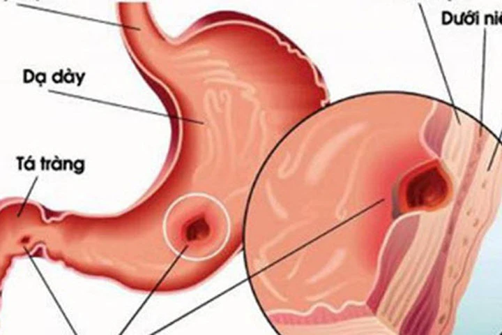 7 bí quyết bảo vệ dạ dày hiệu quả nhất ai cũng nên biết