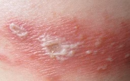 Để phòng ngừa zona thần kinh, bệnh nhân nên đến khám sớm khi bắt đầu có thương tổn ở da để được điều trị thuốc kháng virus trong thời gian vàng. Ảnh minh họa