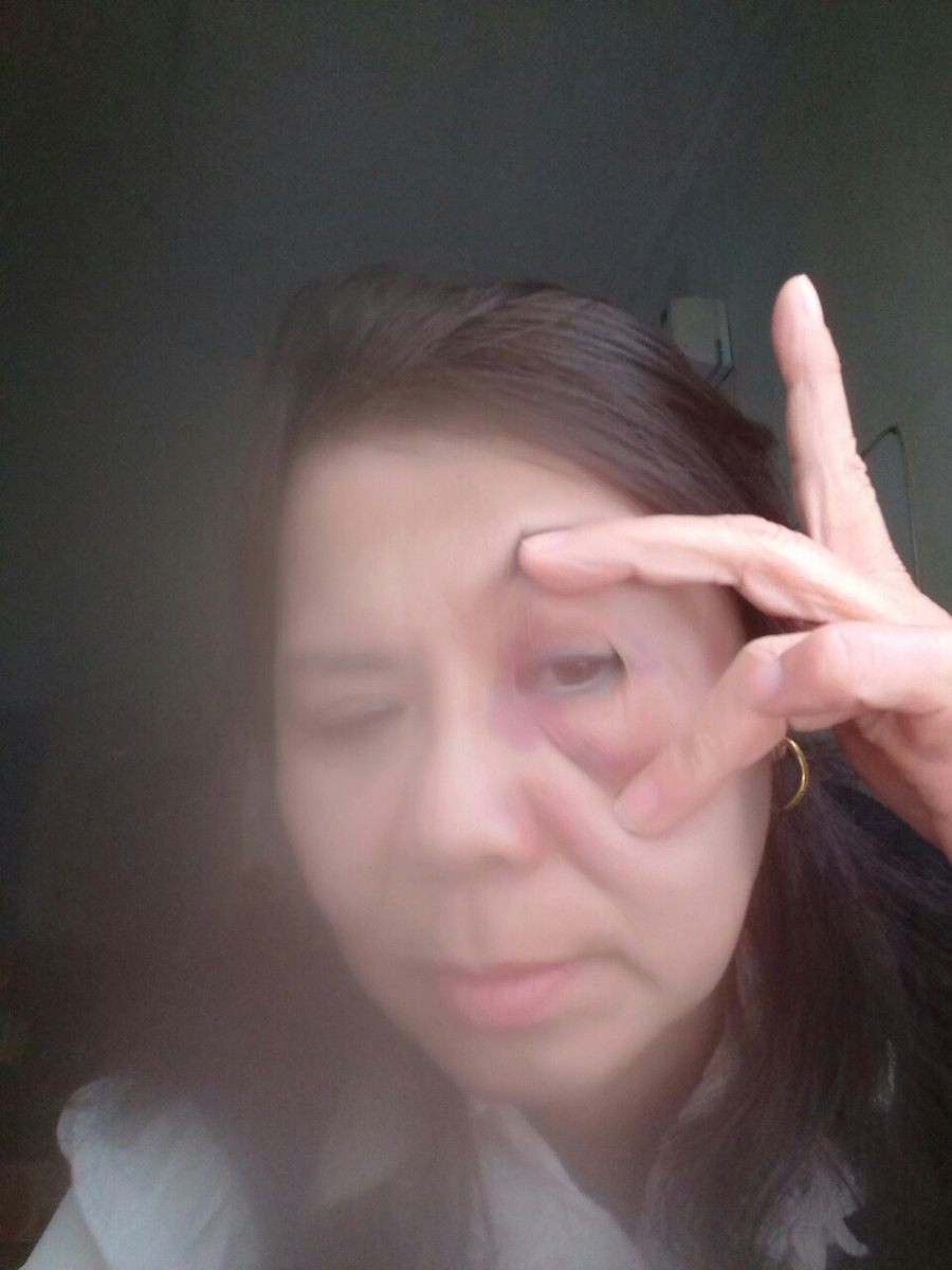 Cô Nguyễn Thị Lan - giáo viên Trường Tiểu học Đại Nghĩa - cho biết, vết bầm tím là do bị hiệu trưởng đánh. Cô Nguyễn Thị Lan - giáo viên Trường Tiểu học Đại Nghĩa - cho biết, vết bầm tím là do bị hiệu trưởng đánh.