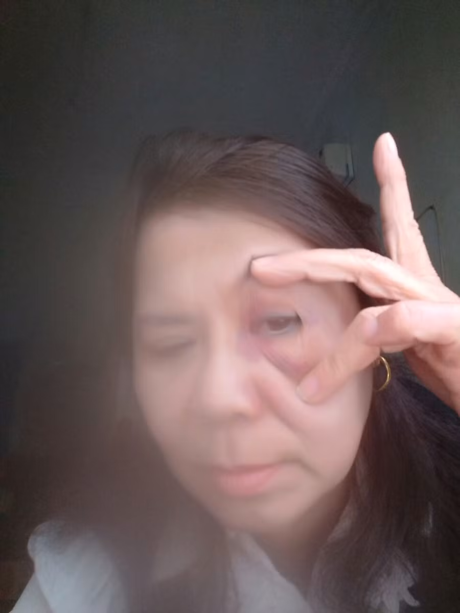 Cô Nguyễn Thị Lan - giáo viên Trường Tiểu học Đại Nghĩa - cho biết, vết bầm tím là do bị hiệu trưởng đánh.