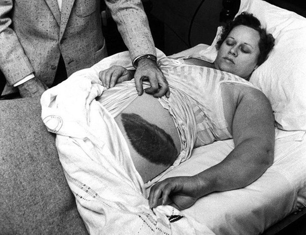 Nạn nhân Ann Elizabeth Hodges sống sót sau khi bị mảnh thiên thạch va vào hông.