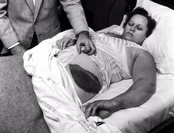 Nạn nhân Ann Elizabeth Hodges sống sót sau khi bị mảnh thiên thạch va vào hông.