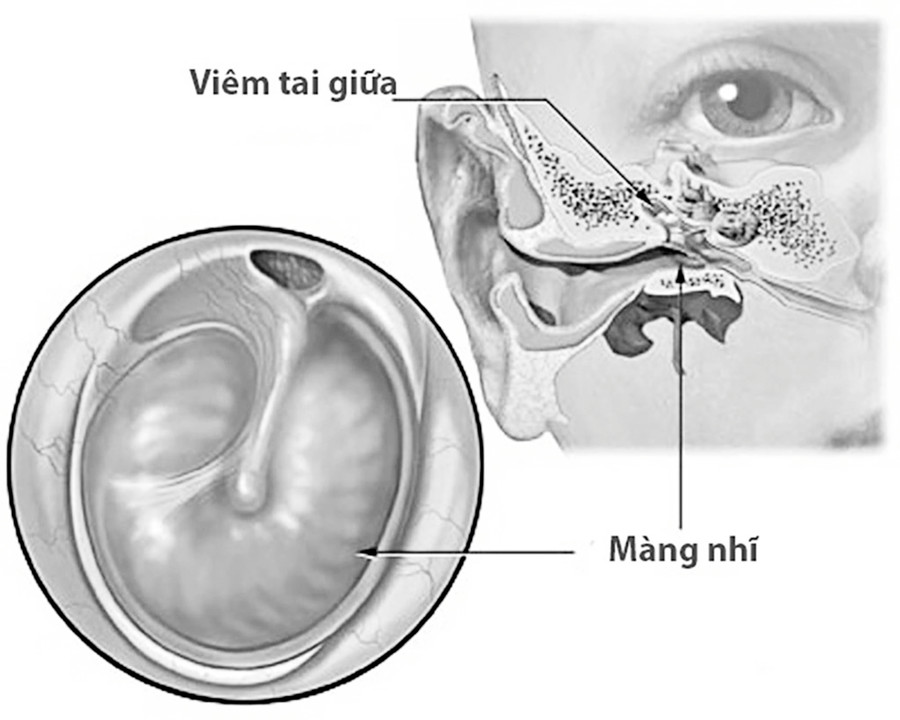 Viêm tai giữa cấp là bệnh nhiễm trùng khởi phát đột ngột, nguyên nhân phổ biến do vi khuẩn hoặc virus xâm nhập ở tai giữa. Ảnh minh họa Viêm tai giữa cấp là bệnh nhiễm trùng khởi phát đột ngột, nguyên nhân phổ biến do vi khuẩn hoặc virus xâm nhập ở tai giữa. Ảnh minh họa