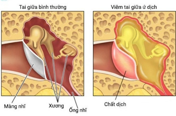 Tai giữa bình thường (bên trái) và viêm tai giữa ứ dịch.