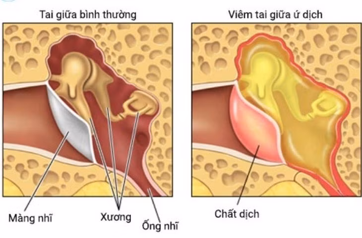 Tai giữa bình thường (bên trái) và viêm tai giữa ứ dịch.