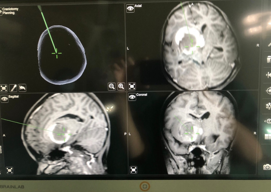 Ca mổ được thực hiện dưới kính hiển vi có hệ thống dẫn đường đảm bảo độ chính xác cao