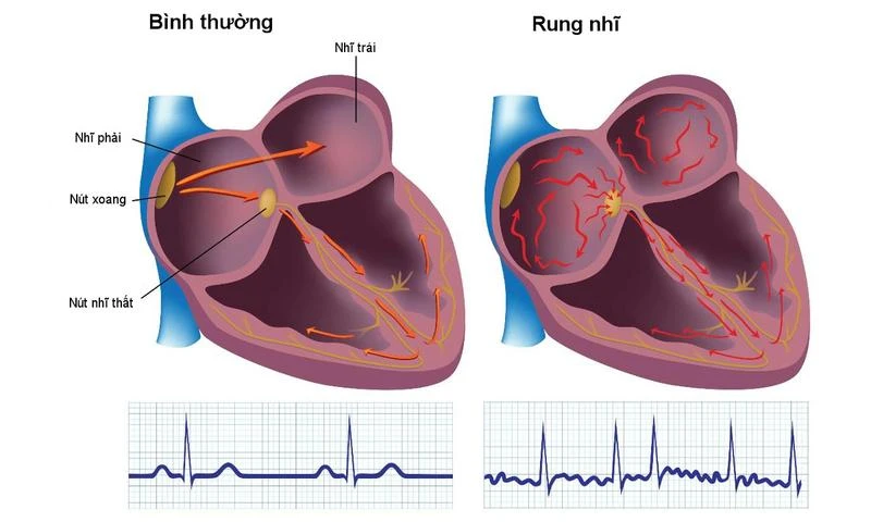 Hình ảnh tai bình thường và tai khi xuất hiện rung nhĩ.