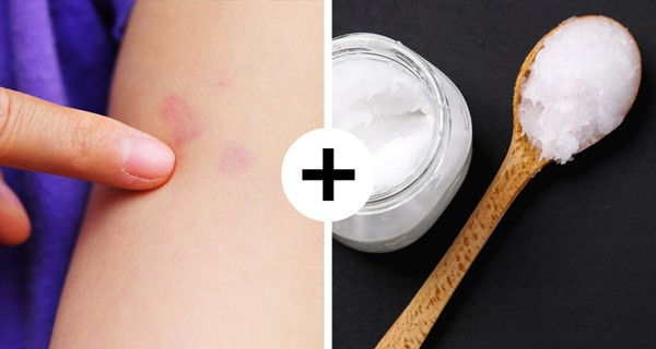 10 mẹo sơ cứu nhất định phải biết, có thể giúp bạn thoát chết trong gang tấc-8