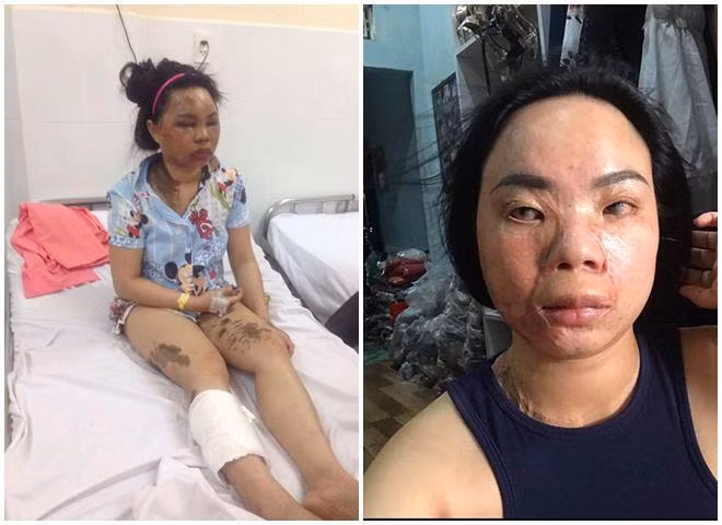 co gai xinh dep bi tat axit bien dang, ban trai 5 nam nhin thay chi noi dung 1 cau - 3